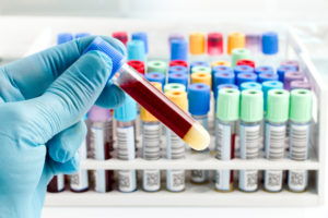 Diagnosing Cancer With A Simple Blood Test