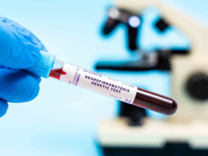DoW Neurofibromatosis Exploration-Hypothesis Development Award