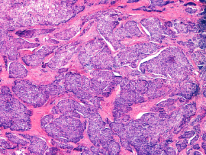 DoW, Ovarian Cancer, Pilot Award